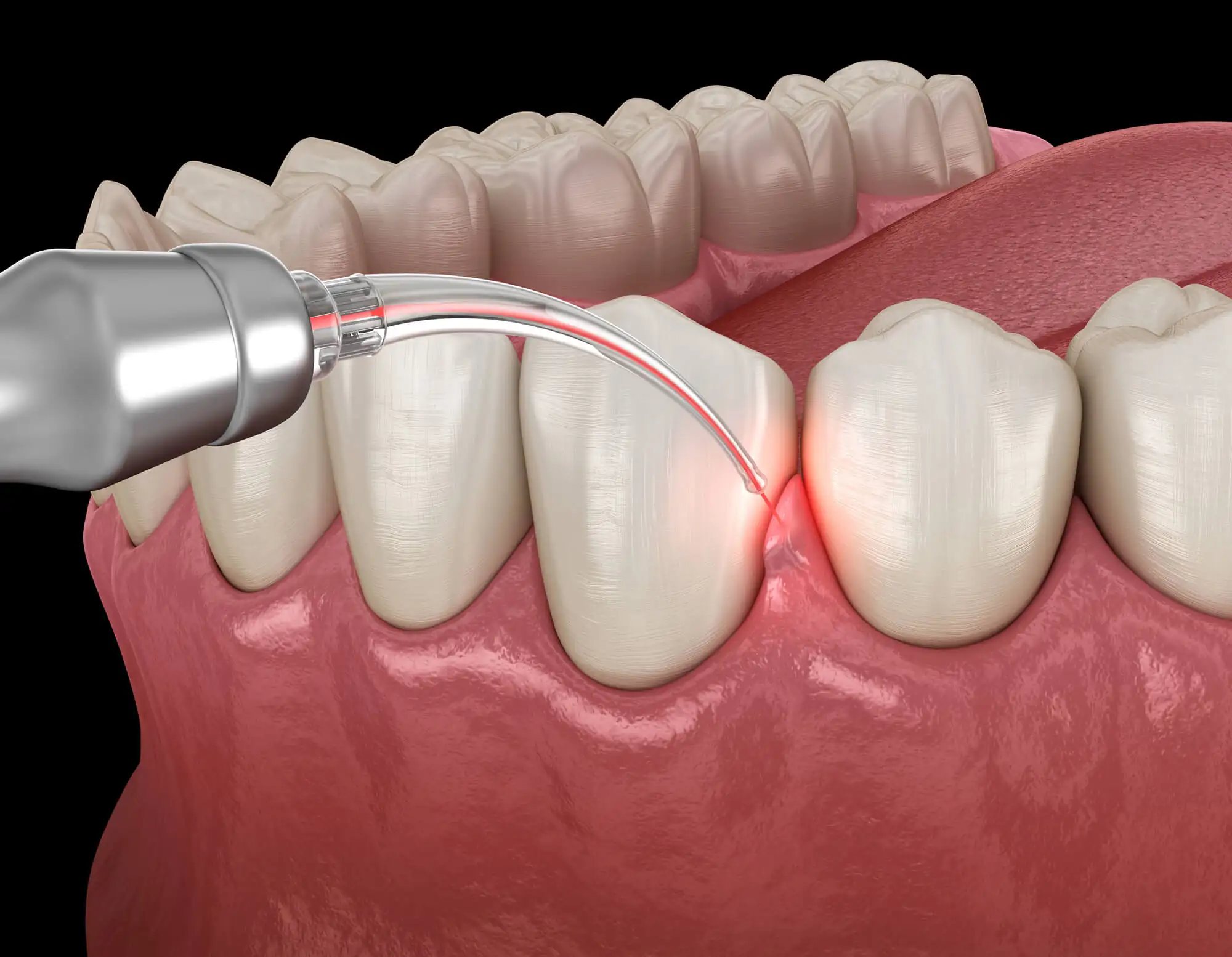 dental laser graphic