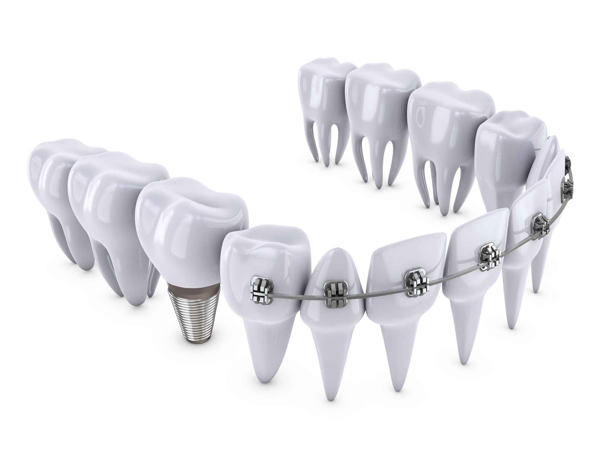 A set of teeth with braces attached to them.